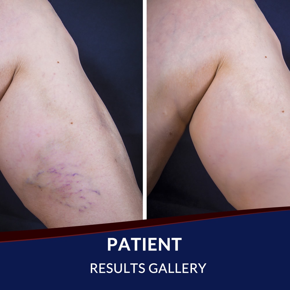 Patient Before After Gallery - Arteries and Veins Center - El Paso, TX