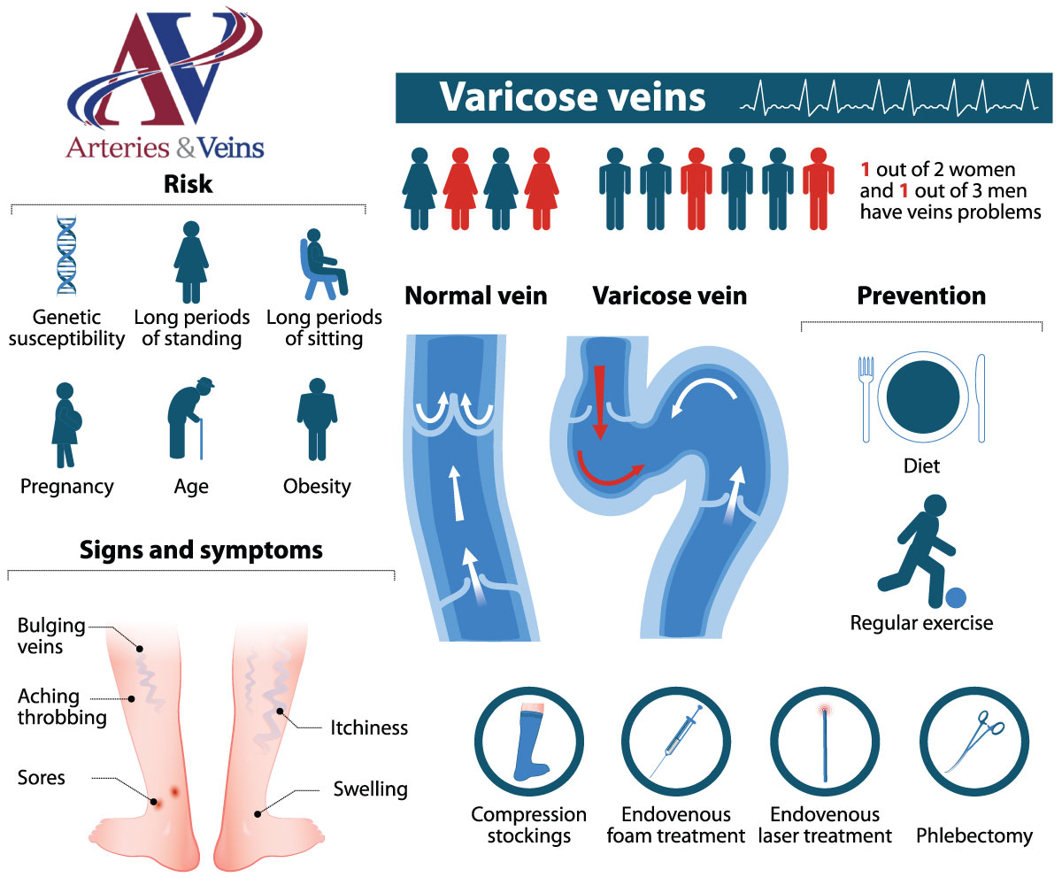 Varicose Veins Treatment in El Paso and Las Cruces