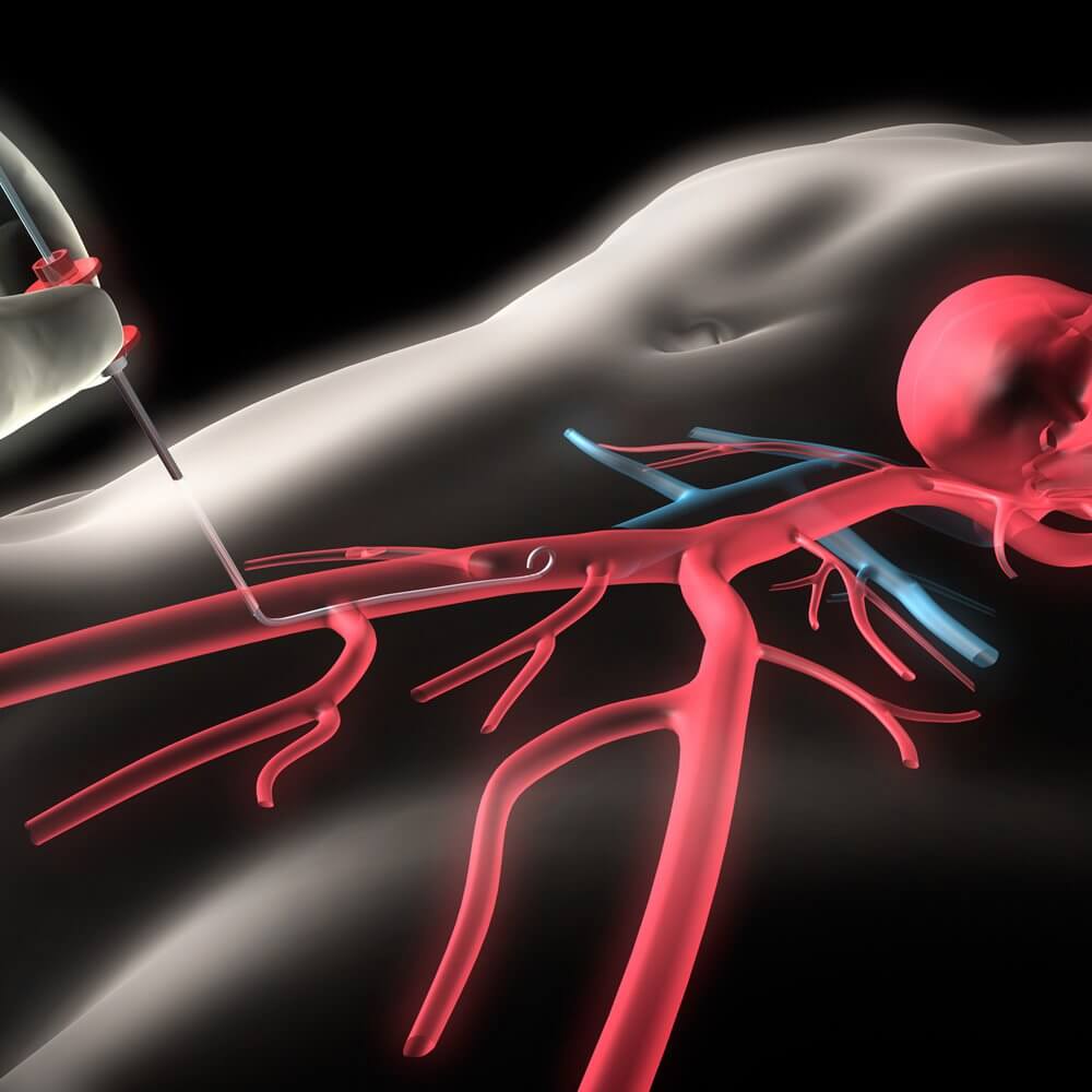 Central Venous Access