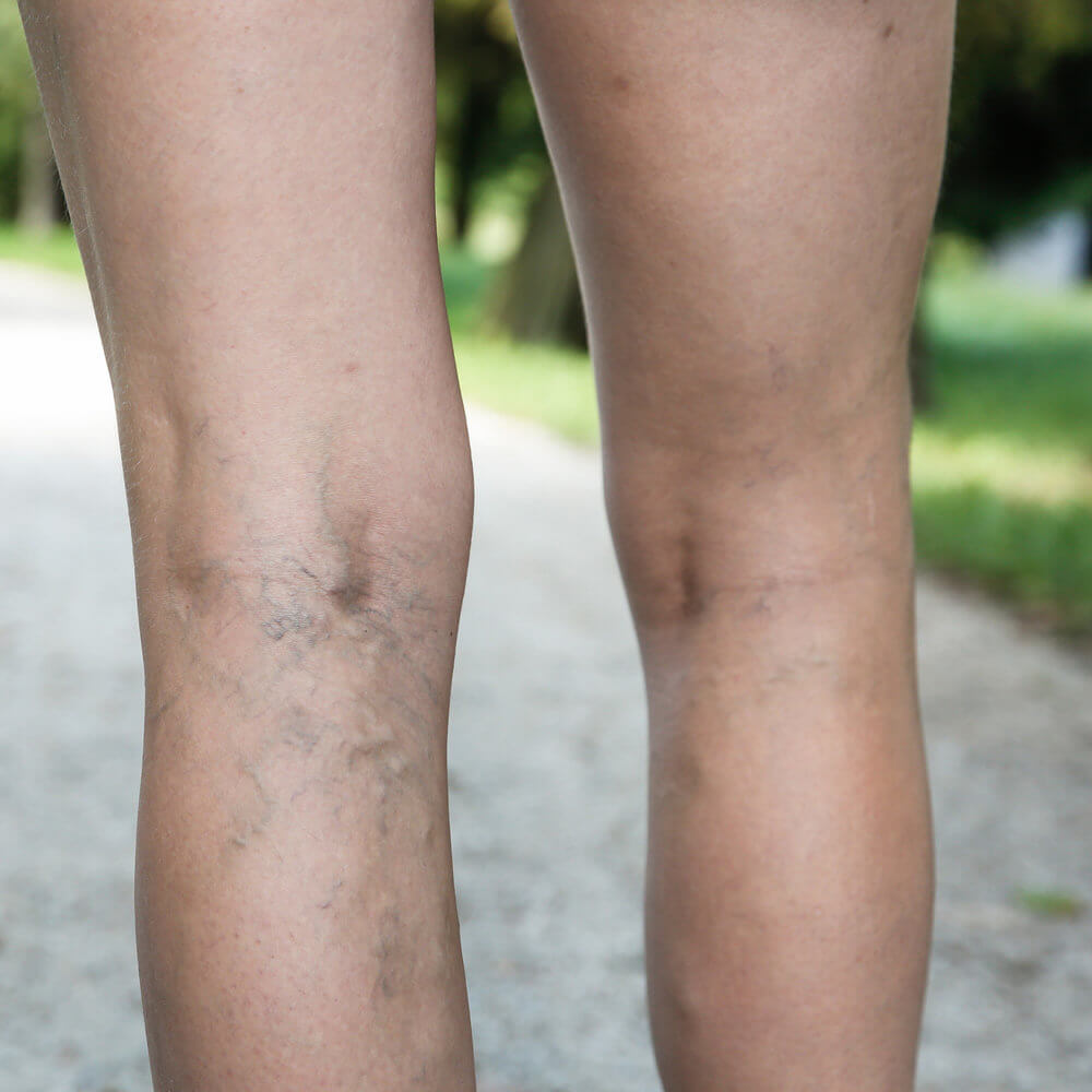 Spider Veins