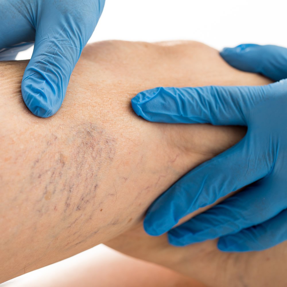 Varicose Veins